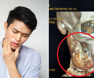 Đau răng 1 năm mới đi khám, cậu bé 15 tuổi khiến bác sĩ sốc khi bị 'ăn mòn' 1 nửa xương hàm phải do ung thư