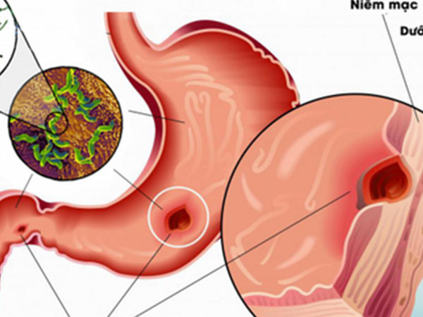 Ảnh bìa bài viết 525634