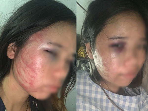 Xót xa người vợ mang bầu 7 tháng vẫn bị chồng đánh bầm dập, đau lòng hơn khi bố ruột vừa mới qua đời