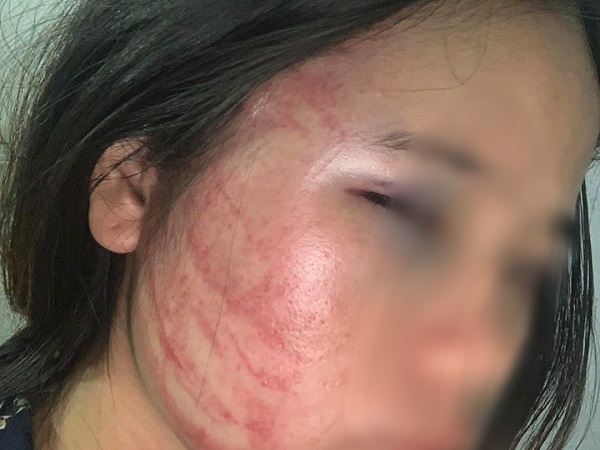 Xót xa thay thân phận đàn bà: Mang bầu 7 tháng còn bị chồng ăn nhậu về đánh đập dã man