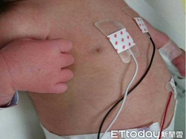 Bé trai 15 ngày tuổi sốt kéo dài, chân tay sưng đỏ vì mắc căn bệnh dễ nhầm lẫn với cảm thông thường