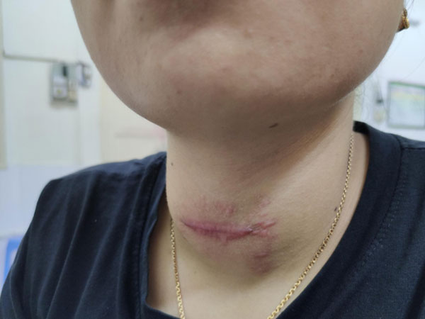 Cô gái bị loét vùng cổ do tin vào thầy lang chữa bệnh basedow và lời khuyến cáo của bác sĩ