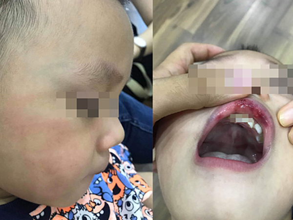 Cô giáo ở Hà Nội tát bé hơn 2 tuổi sấp mặt, tụ máu môi đang bị hoảng loạn và có suy nghĩ quẩn