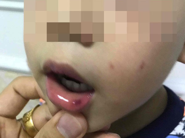 Lá thư xin lỗi gửi lúc đêm muộn của cô giáo ở Hà Nội tát bé hơn 2 tuổi sấp mặt, tụ máu môi