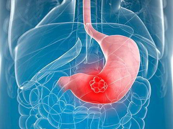 Người đàn ông 31 tuổi bị ung thư dạ dày do ăn thứ này thay cơm trong thời gian dài