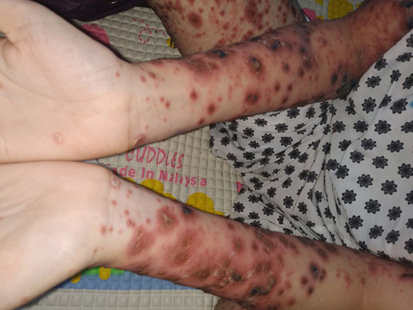 Bé gái Việt Nam đầu tiên mắc bệnh chỉ 38 bệnh nhi thế giới mắc phải