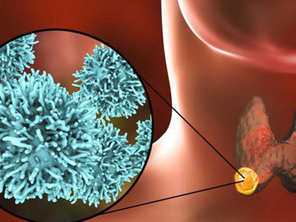 13 tuổi mắc ung thư tuyến giáp: BS cảnh báo bệnh liên quan tới thói quen ăn thiếu chất