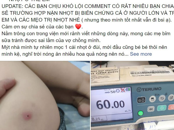 Trẻ 3 tuổi sốt cao, nhiễm trùng máu vì tự ý nặn mụn: Bác sĩ cảnh cáo 4 sai lầm bố mẹ hay làm có thể 'mất con'