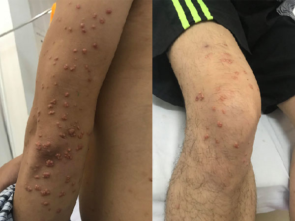Tự ý nặn những nốt mụn ngoài da, không ngờ đi khám đó là u vàng phát ban rối loạn lipid máu hỗn hợp