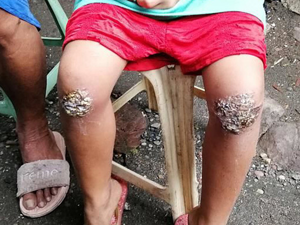 Mẹ bắt con 8 tuổi quỳ trên than nóng vì quên mang ba lô về nhà