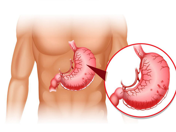 Tại sao bệnh dạ dày lại có thể tiến triển thành ung thư: Nhiều người không chú ý điều này