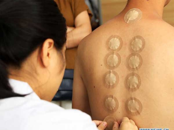 92 trẻ em bị bỏng rát sau khi dùng miếng dán tăng cường miễn dịch, chuyên gia khuyến cáo không được tự ý dùng!