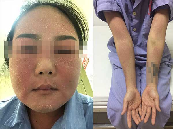 Dùng mỹ phẩm làm trắng da trôi nổi cô gái trẻ bị phù nề toàn bộ da mặt, nhiễm trùng toàn thân