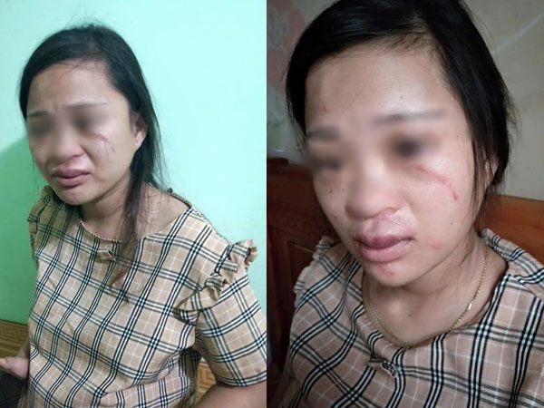 Mua đôi giày 135 ngàn, thai phụ 8 tháng bị mẹ chồng nói theo trai rồi xúi con đánh chảy máu mắt, bầm tím người