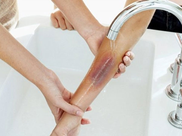 Bé 2 tuổi ngã vào chảo dầu sôi, hành động tưởng cứu nguy của cha mẹ hóa ra hại con