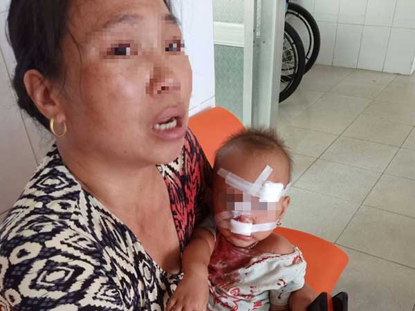 Mẹ bé gái bị cha ruột ném ly vào mặt, khâu 12 mũi: 'Lúc 13 tháng, con bé cũng bị ném vật cứng làm chấn thương sọ não'