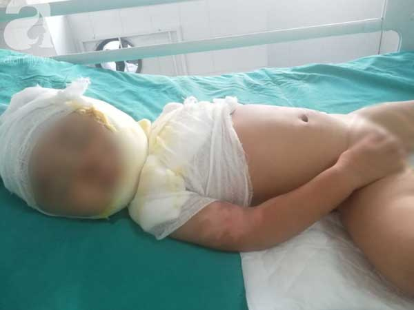 Vụ chồng tẩm xăng thiêu sống cả nhà vì vợ dỗ con không nín: Người mẹ hoảng loạn, bé trai 2 tuổi bị nhiễm trùng nặng