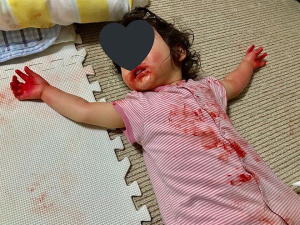 Vắng mặt ít phút, mẹ suýt ngất khi thấy con gái nằm im, khắp người toàn màu đỏ