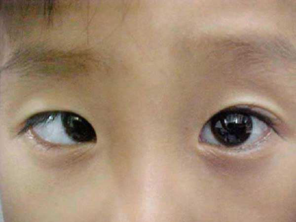 Cậu bé 10 tuổi bất ngờ bị... lác sau khi chơi điện thoại ròng rã 10 tiếng/ngày trong suốt kỳ nghỉ hè