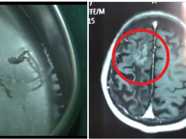 Người đàn ông bị đau đầu suốt 30 năm do kí sinh trùng 10cm sống trong não, bác sĩ lấy ra ngoài vẫn ra sức ngọ nguậy