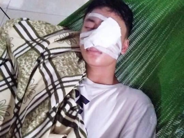 Nam Định: Nam sinh lớp 10 bị nát mặt vì chó lạ tấn công