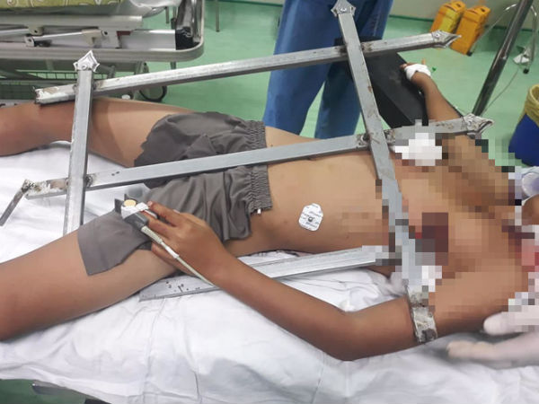 Trèo cây ngã xuống, cậu bé 13 tuổi bị chông hàng rào đâm xuyên dọc ngực