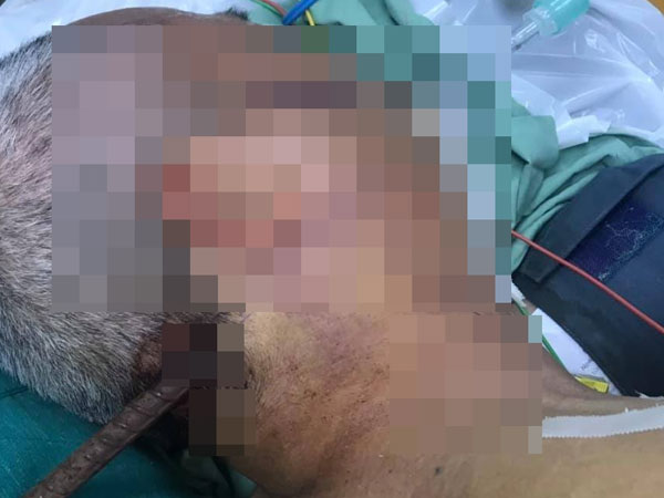 Đắk Lắk: Cứu sống bệnh nhân bị thanh sắt phi 10 cắm từ sau gáy đến góc hàm dưới