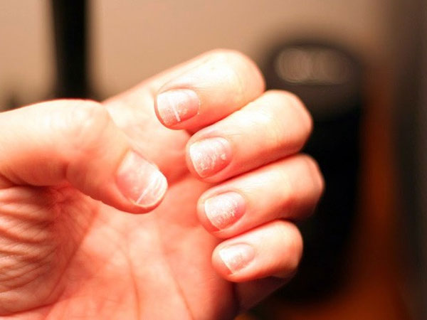 Móng tay vàng là dấu hiệu cảnh báo những vấn đề sức khỏe nghiêm trọng này