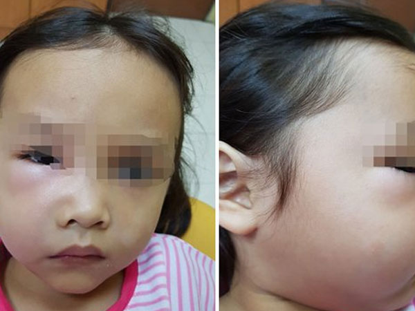 Bé gái suýt chết vì sâu răng, nha sĩ trách cha mẹ hại con vì thói quen tai hại