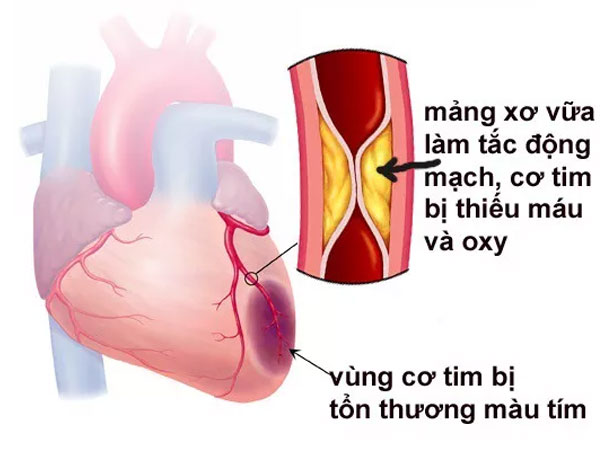 Căn bệnh khiến NSND Thế Anh qua đời là nguyên nhân gây đột tử hàng đầu, nhiều người trẻ mắc