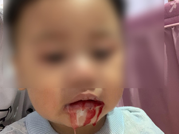 Bé trai chảy máu miệng, 'mất' hết răng vì nhiễm khuẩn từ hành vi vô ý của người lớn