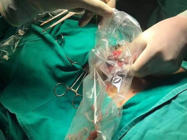 Từ vụ lấy búi giun trong bụng bé 11 tuổi, cha mẹ làm ngay việc này kẻo sau hối tiếc
