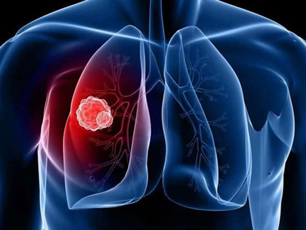 5 giải pháp đơn giản nhất để ngăn ngừa ung thư phổi: Mỗi người đều nên áp dụng sớm
