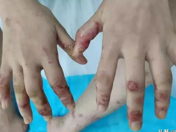 Chân tay lở loét chỉ vì ăn cá, cô gái 19 tuổi ngỡ ngàng khi bác sĩ tiết lộ nguyên do đằng sau