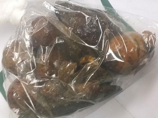 Dạ dày người đàn ông chứa toàn hạt xoài, quả chanh leo nguyên dạng