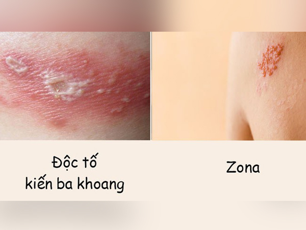 Phân biệt vết thương do kiến ba khoang với viêm da do zona để tránh dùng sai thuốc khiến bệnh càng khó chữa