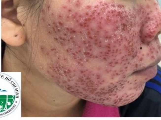 Mặt tiền tan nát, vỡ mộng trắng sáng vì lột da bằng hóa chất