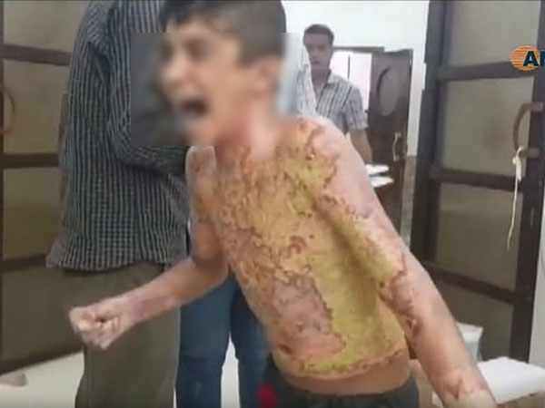 Dư luận quốc tế chấn động trước một loạt hình ảnh trẻ em Syria với những vết bỏng nặng, khoét sâu vào cơ thể do vũ khí hóa học gây ra