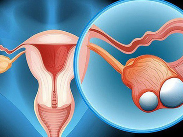 Cô gái 23 tuổi chưa kết hôn đã bị ung thư dạ dày di căn buồng trứng, cảnh báo những thói quen xấu nhiều người mắc