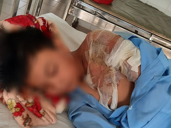 Xác minh thông tin bé trai ở Long An bị cha đẻ bạo hành, đổ nước sôi khiến bỏng nặng phải nhập viện