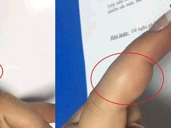 Bị sưng đau ngón tay, người phụ nữ không ngờ mang khối u ở vị trí cực hiếm gặp