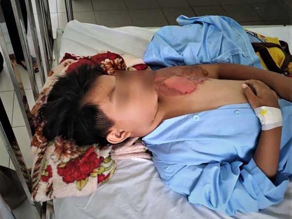 Hoàn cảnh vô cùng bi đát của bé trai nghi bị cha ruột tạt nước sôi gây bỏng nặng