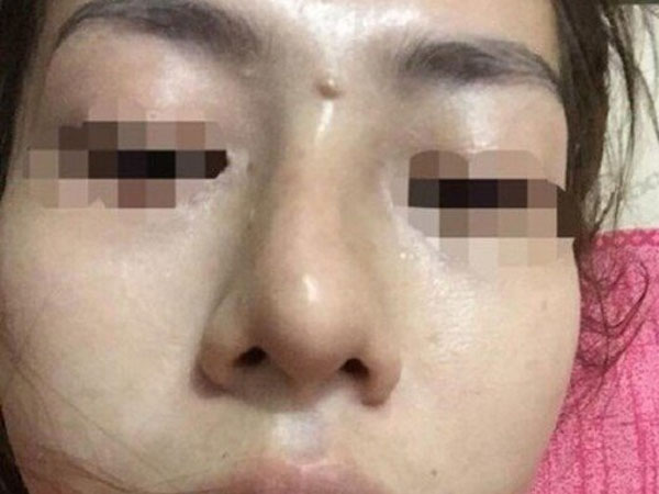 Giấu mẹ đi nâng mũi giá 2 triệu lại được trả góp, bé gái 13 tuổi ở Yên Bái bị mù một bên mắt