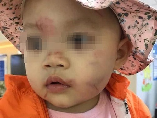 Bé gái 14 tháng tuổi bị nhiều vết bầm tím trên mặt ngay ngày đầu đến lớp