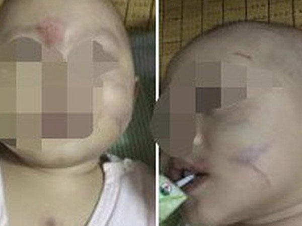 Sau buổi đi học đầu tiên, mẹ đau đớn phát hiện con gái 14 tháng tuổi thâm tím khắp mặt