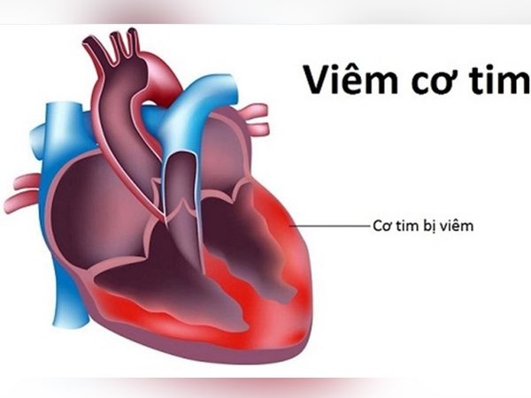 Thực hư virus viêm cơ tim gây chết người đang xôn xao cộng đồng mạng