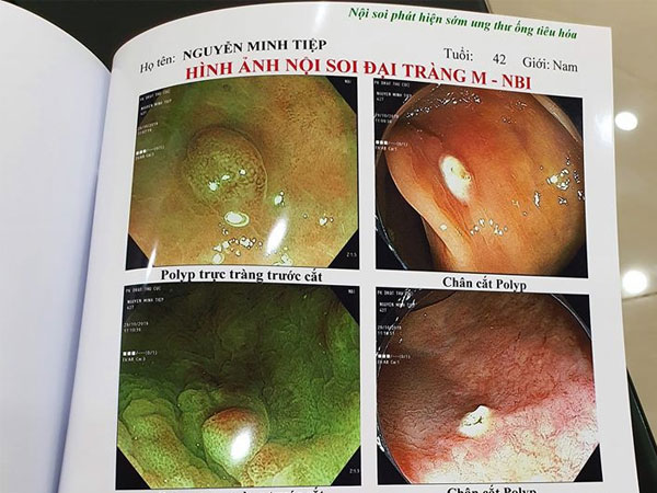 Bệnh polyp đại tràng và polyp dạ dày mà diễn viên Minh Tiệp vừa phát hiện có thể tiến triển thành ung thư không?