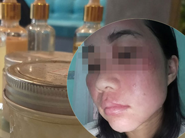 Nhiều người tố một spa Hà Nội bán mỹ phẩm kém chất lượng khiến chị em bị nổi mẩn ngứa, hỏng hết da mặt