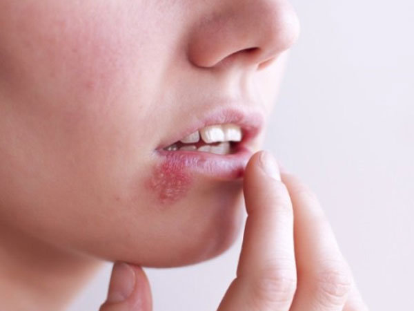 Những nhầm tưởng về mụn rộp sinh dục herpes mà không ít phụ nữ mắc phải