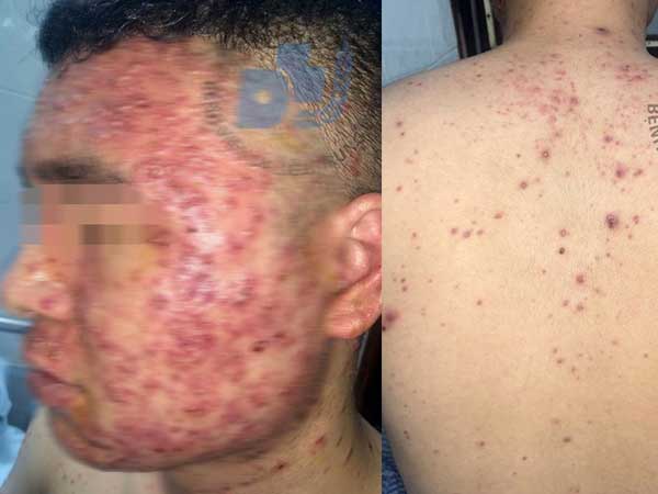 Dùng thuốc trị mụn trứng cá không rõ nguồn gốc khi mua qua facebook, nam thanh niên kinh hãi khi thấy mặt mình